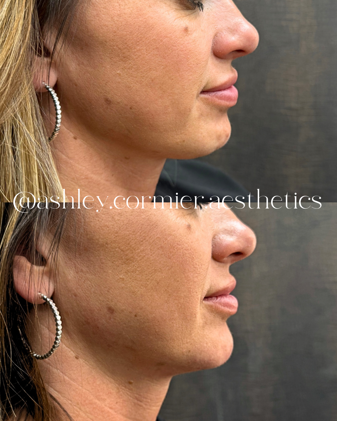 before and after chin filler