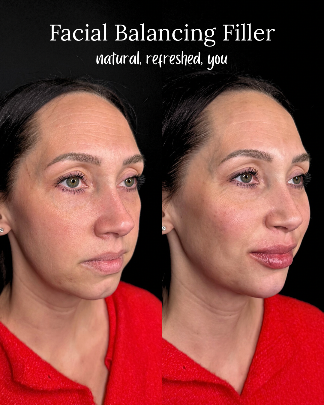 full facial balancing results, cheek, chin, and lip filler