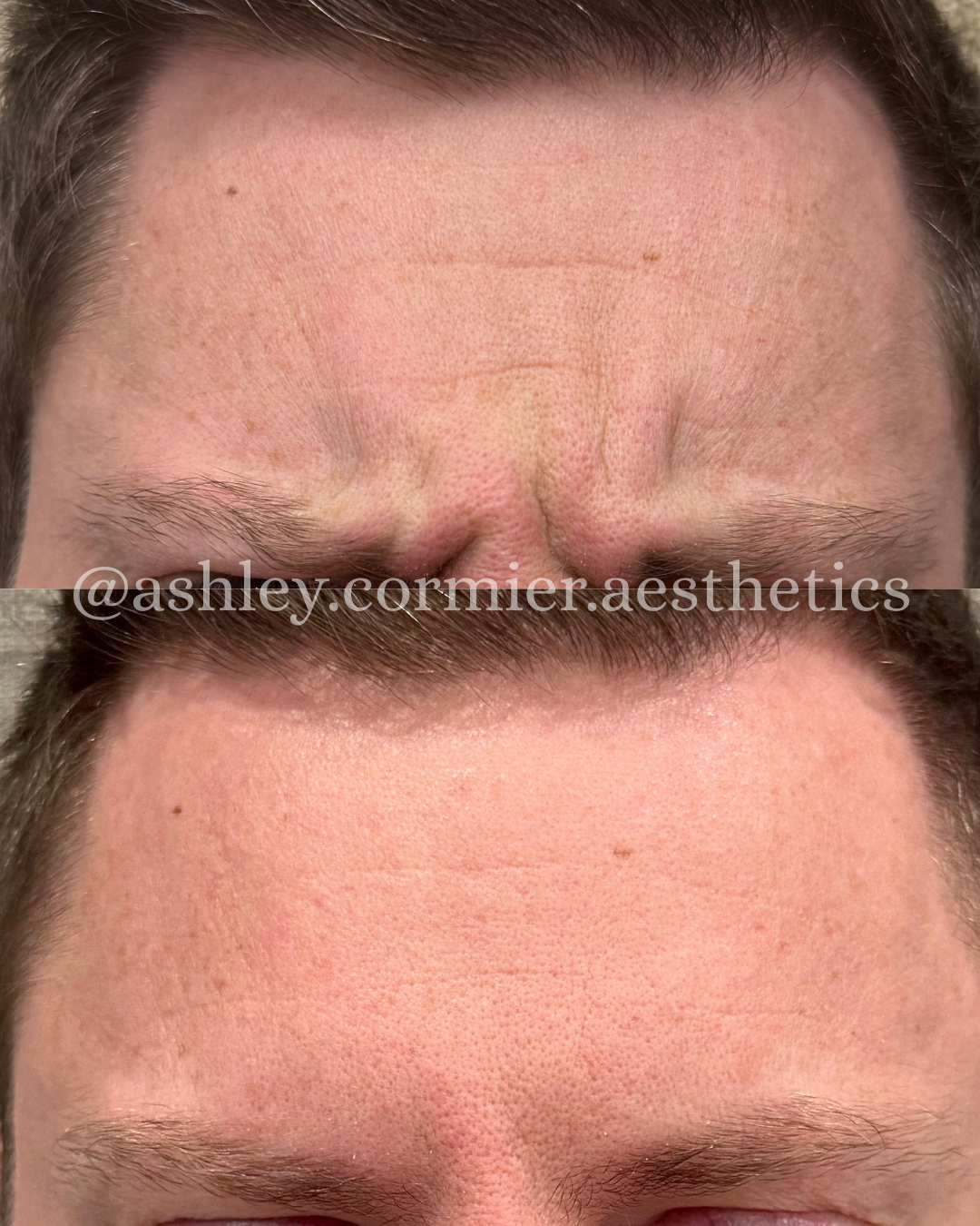 before and after glabella botox