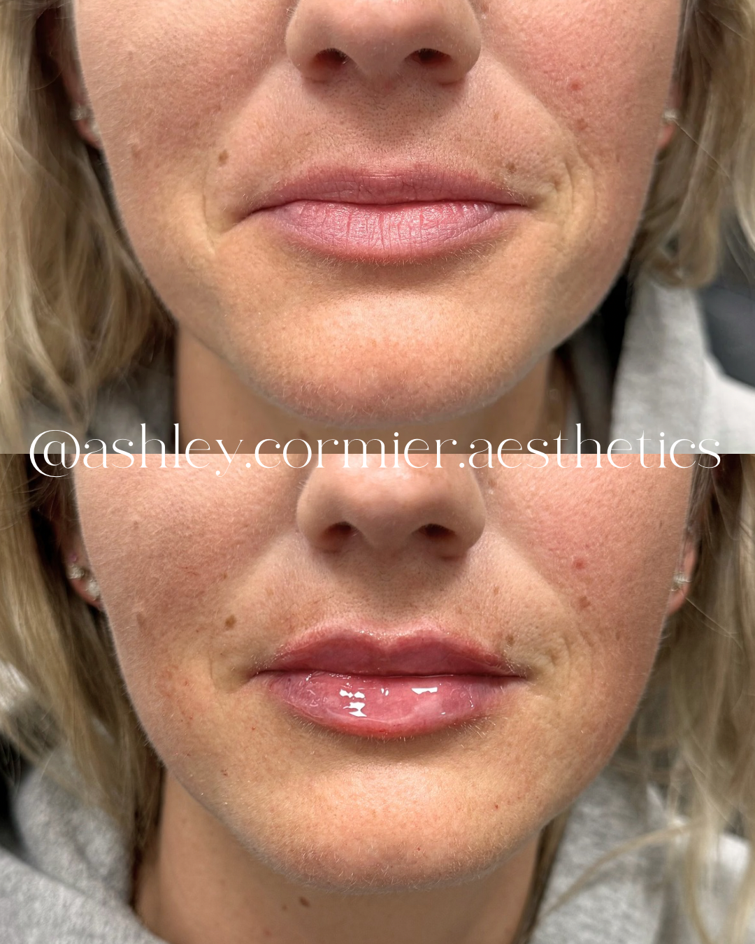 before and after a half syringe of lip filler