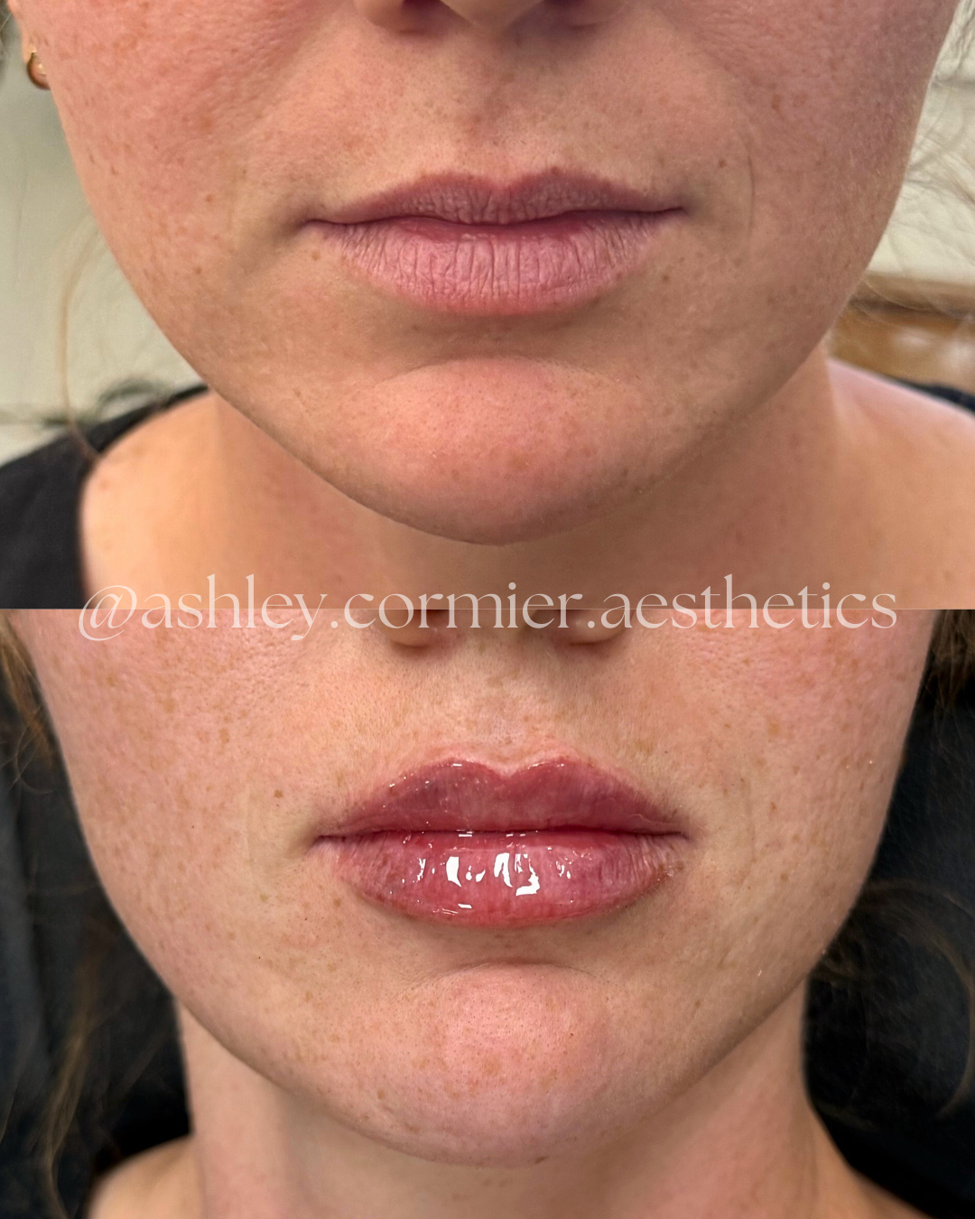 before and after a half syringe of lip filler