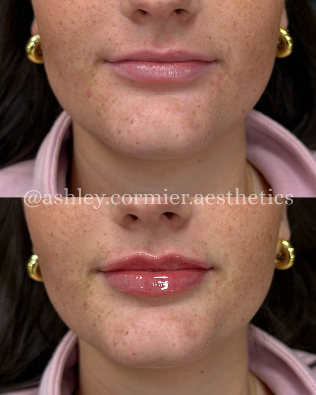 before and after a half syringe of lip filler