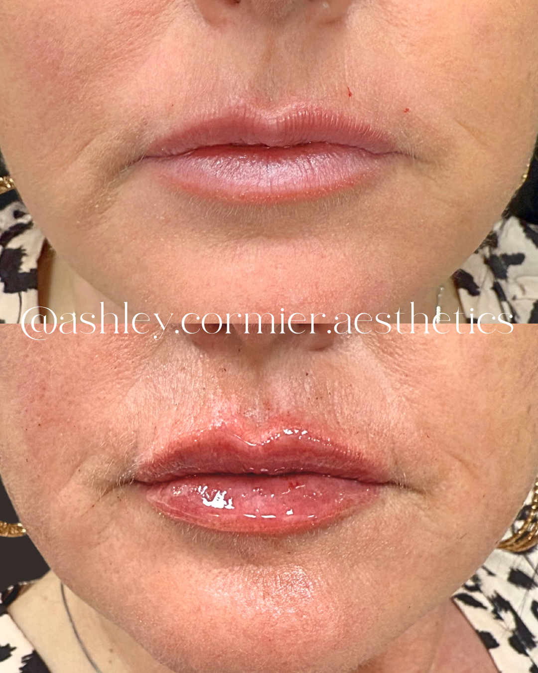 before and after a half syringe of lip filler