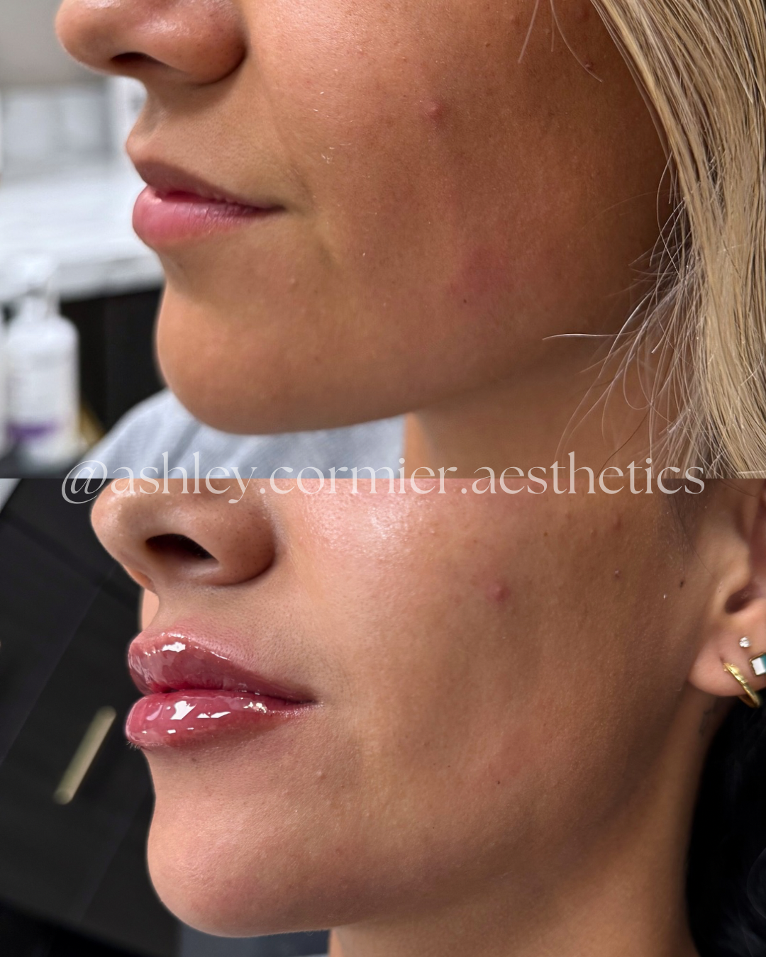 before and after a half syringe of lip filler