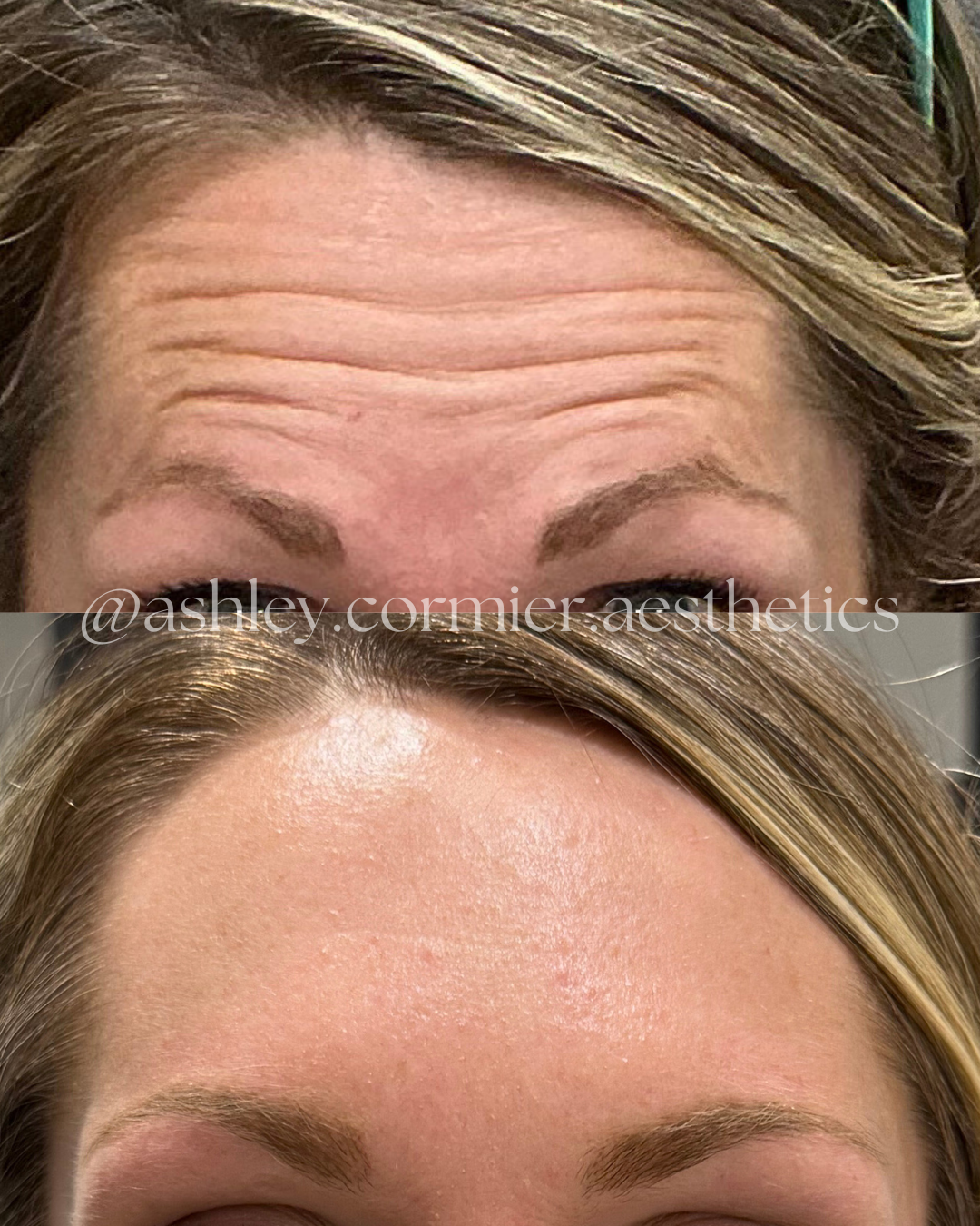 before and after frontalis botox