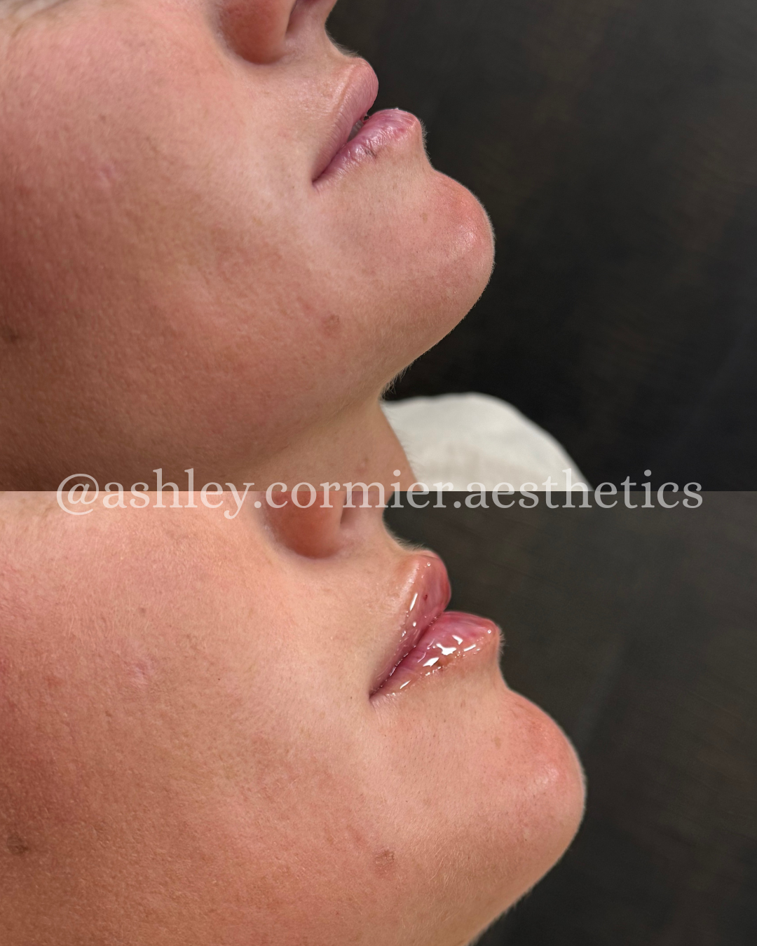 before and after a half syringe of lip filler