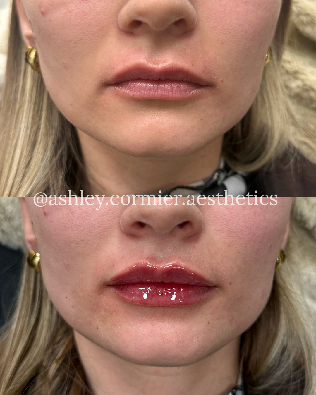 before and after a half syringe of lip filler