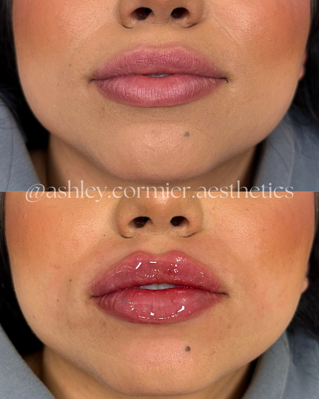 before and after a full syringe of lip filler