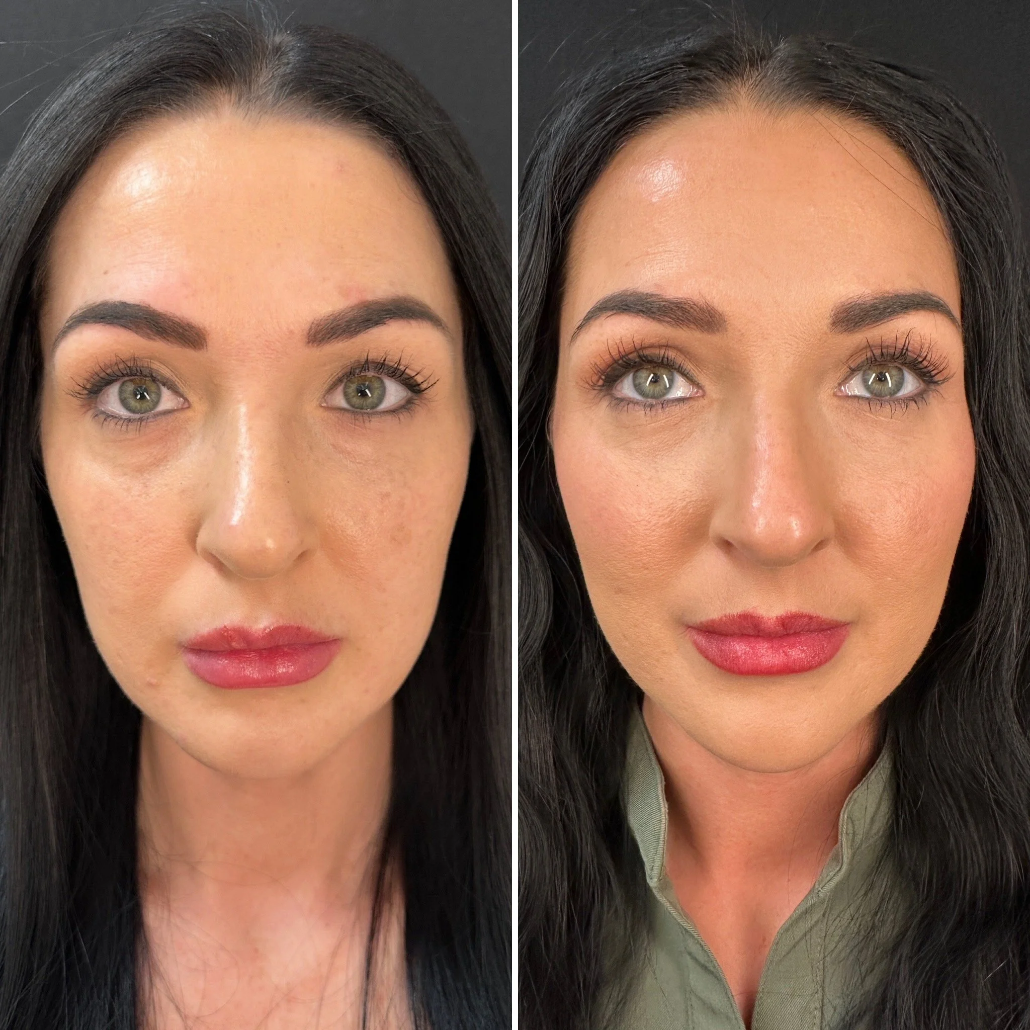 facial balancing filler treatment, cheek filler, chin filler, lip filler, under eye filler dissolved and then under eye PRF treatments done. Full face botox.