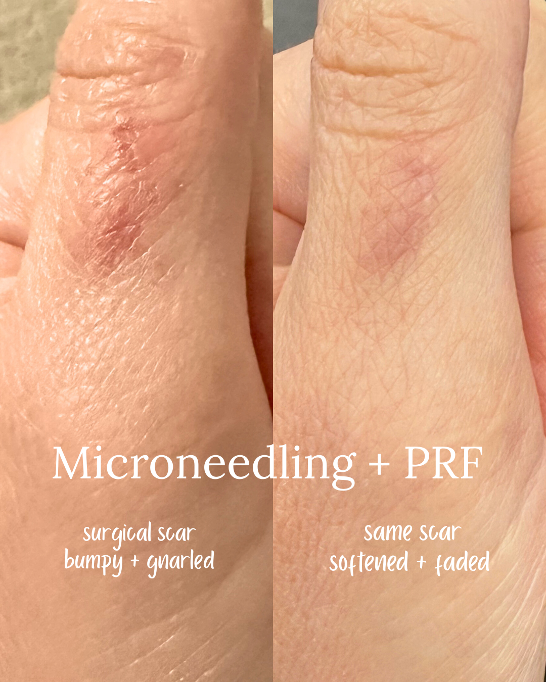 before and after microneedling a scar on the thumb with PRF