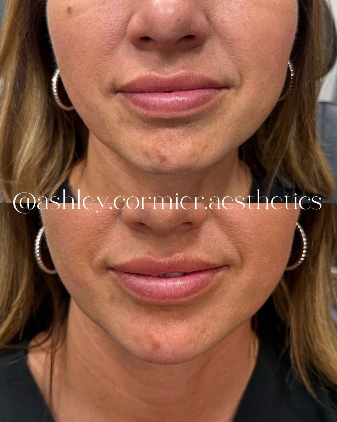 before and after chin filler