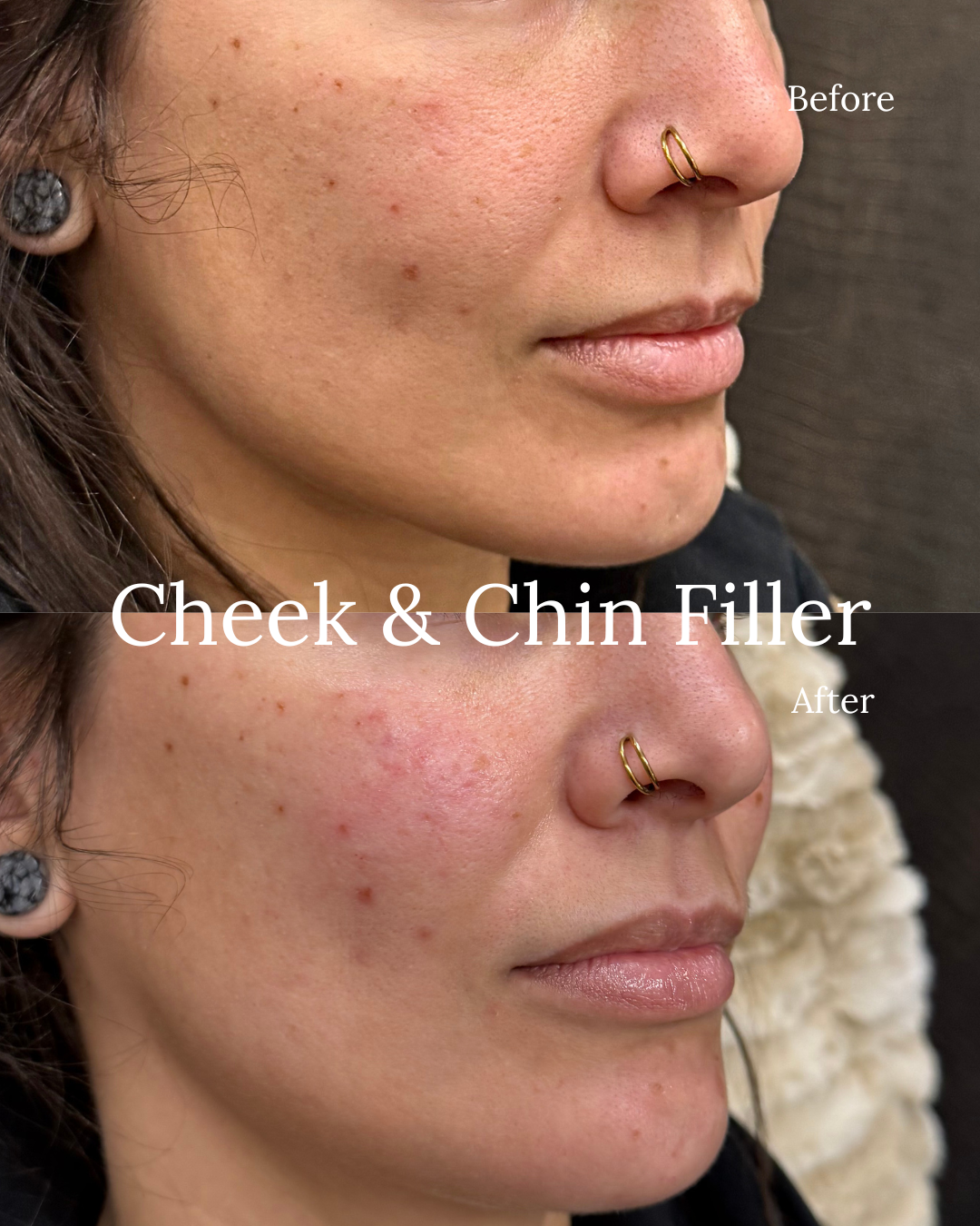 Cheek and chin filler
