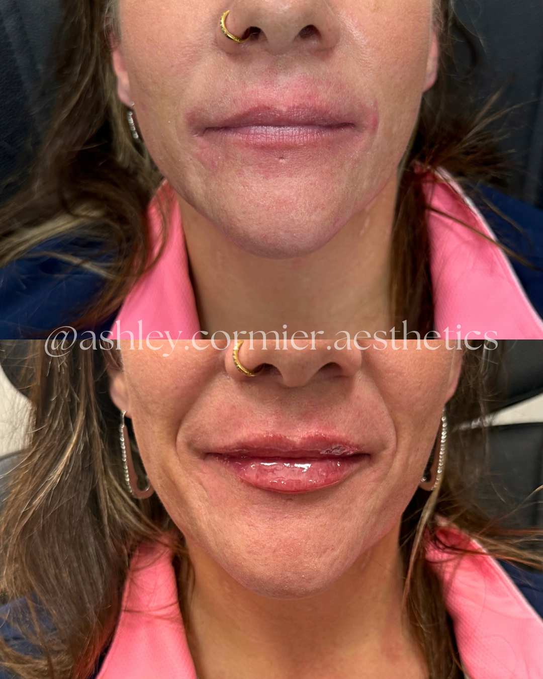 before and after a half syringe of lip filler