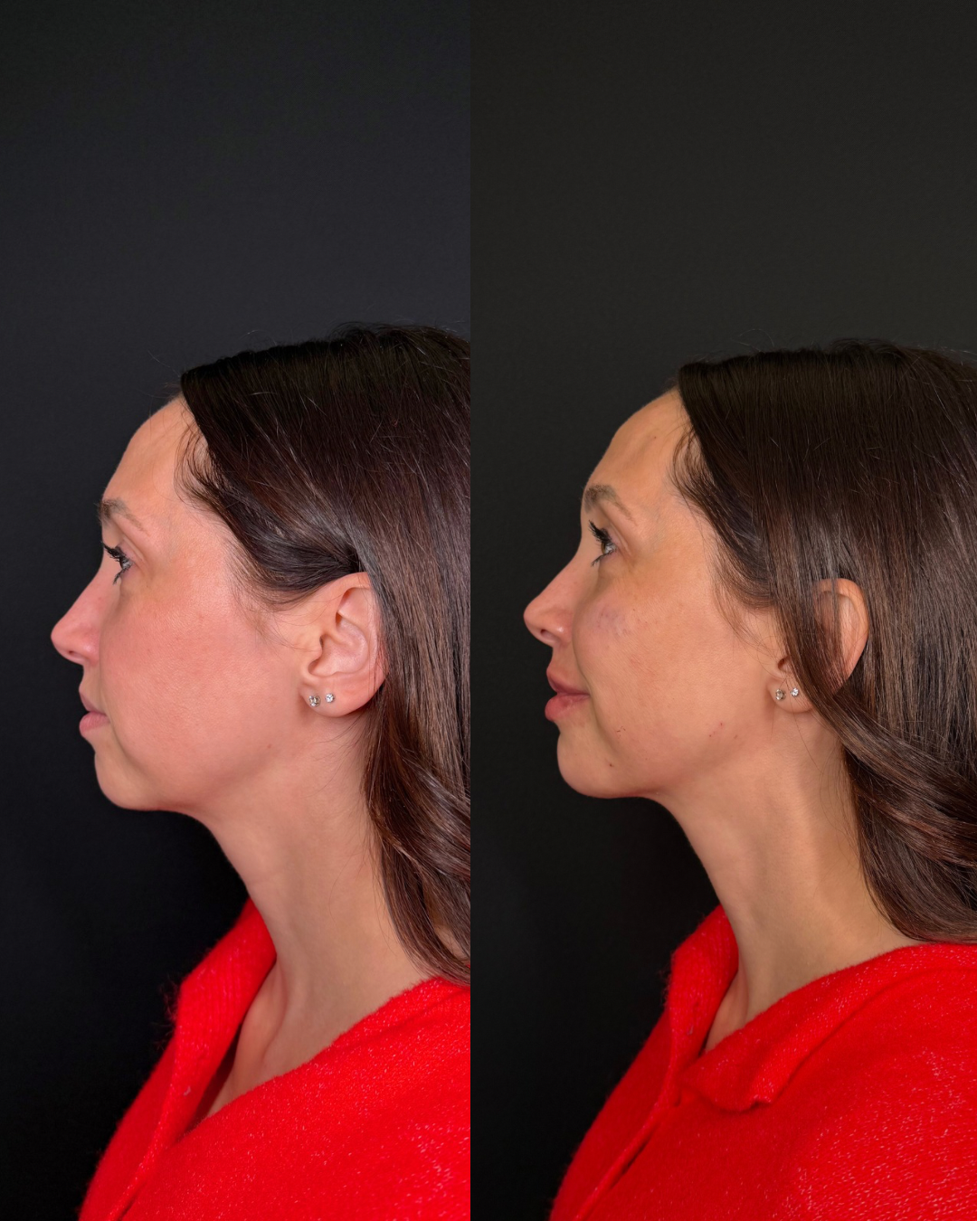 full facial balancing results, cheek, chin, and lip filler