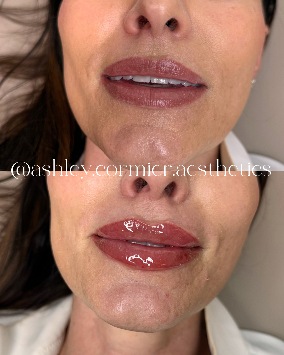 before and after a half syringe of lip filler