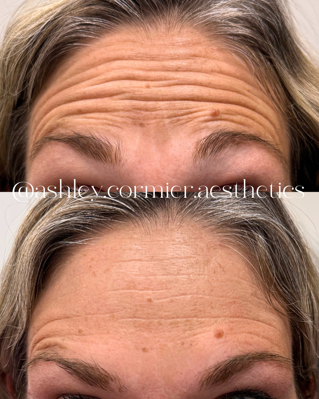 frontalis botox