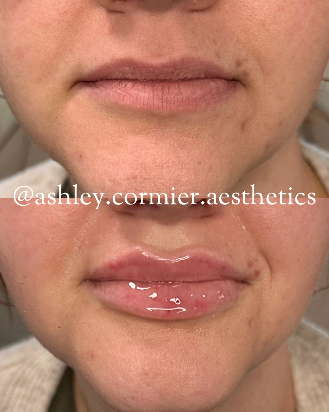 before and after a half syringe of lip filler