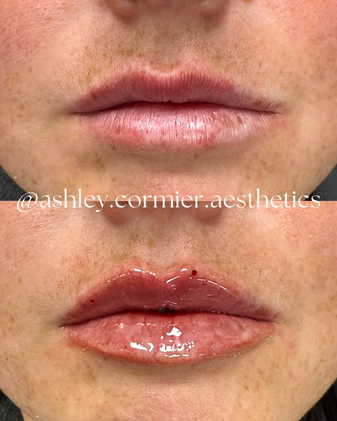 before and after a half syringe of lip filler