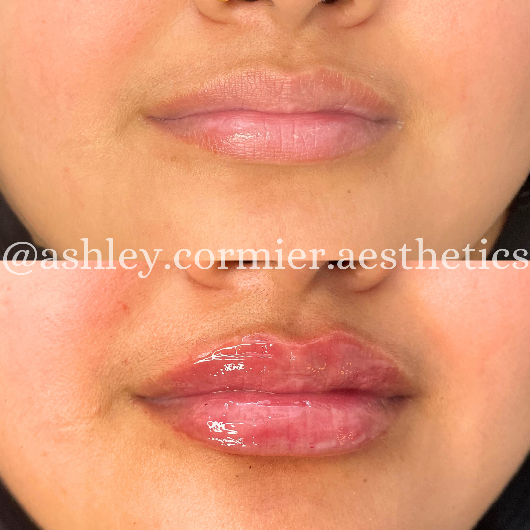 before and after a full syringe of lip filler