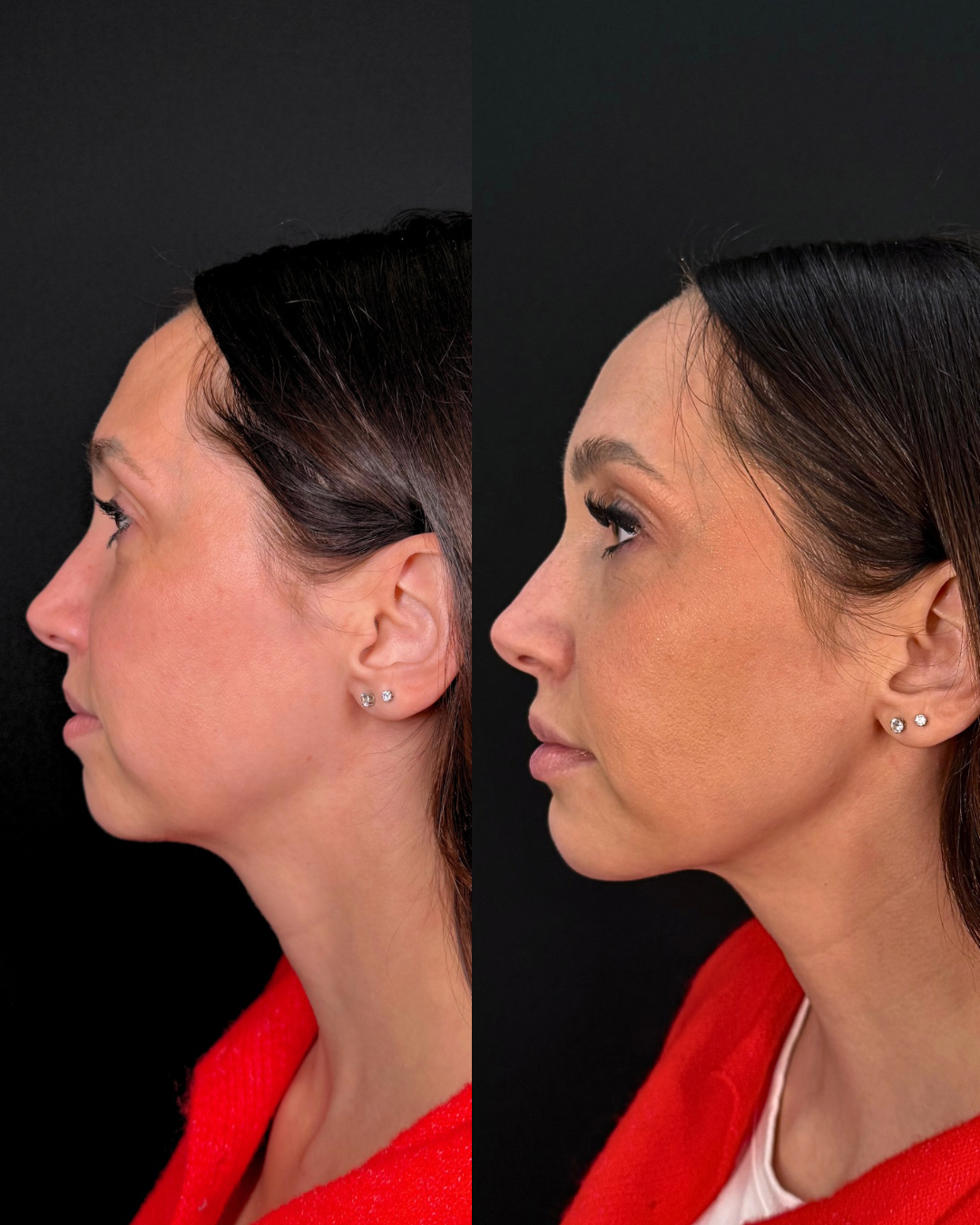 full facial balancing results, cheek, chin, and lip filler