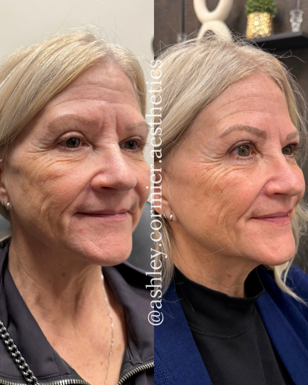 before and after two Sculptra treatments