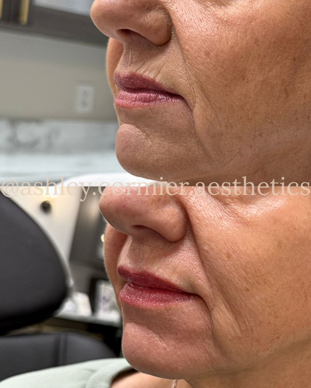 Perioral line + lip filler, microneedling with PDGF