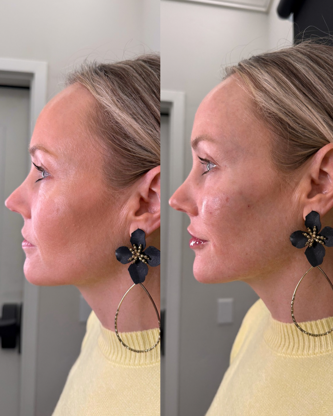 full facial balancing results, cheek, chin, and lip filler
