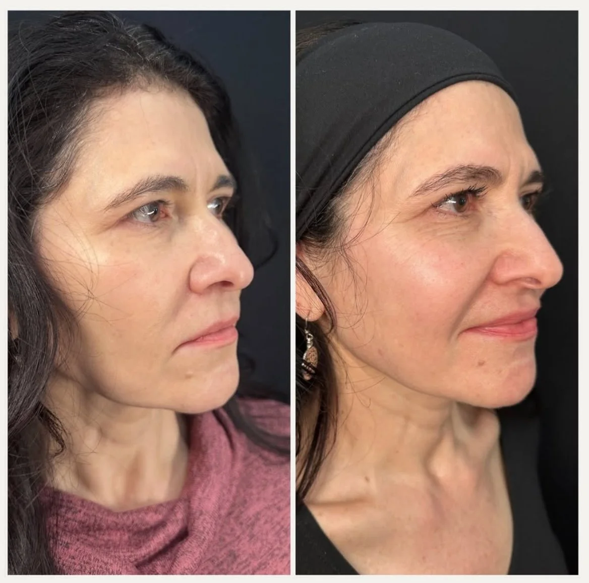 before and after two face and neck Morpheus8 treatments 