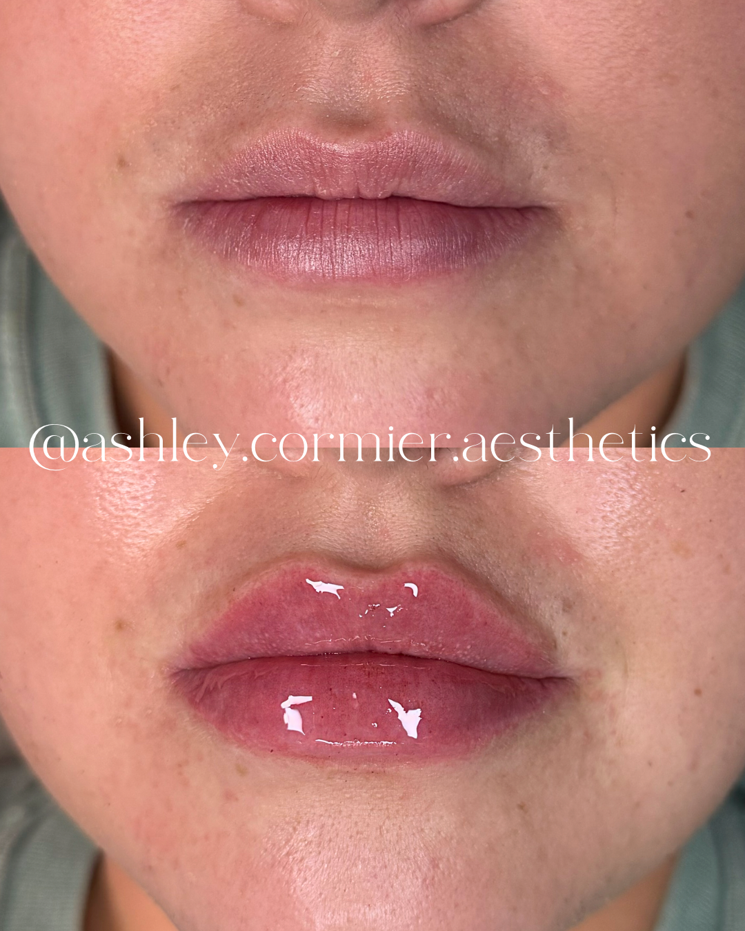 before and after a half syringe of lip filler
