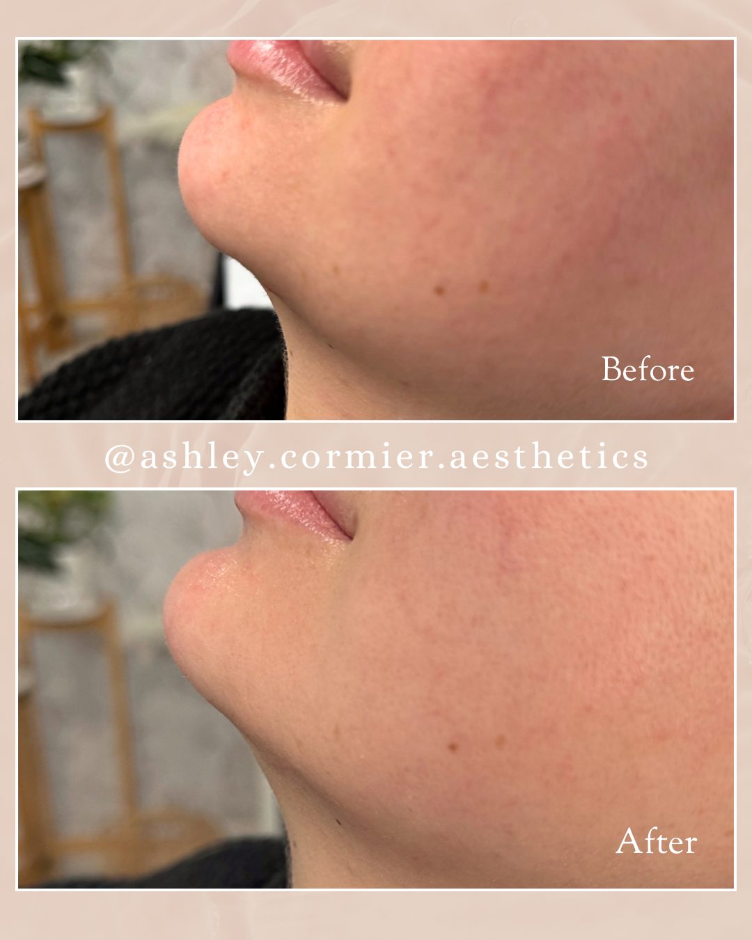 before and after chin and jawline filler