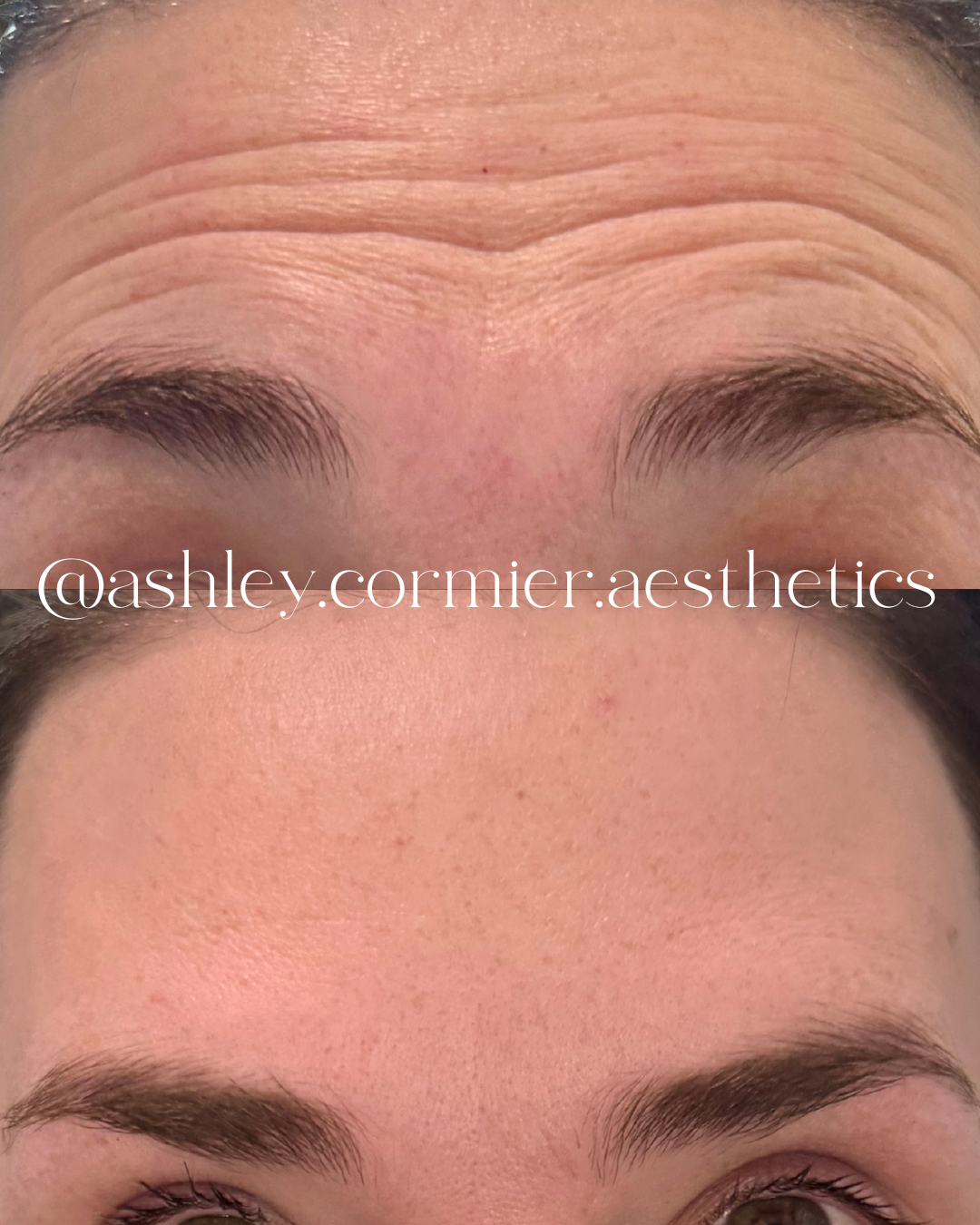 frontalis botox