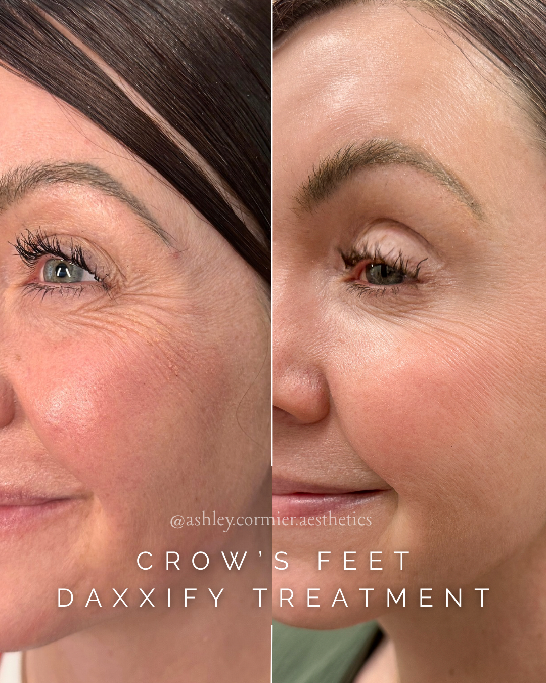 crow's feet botox