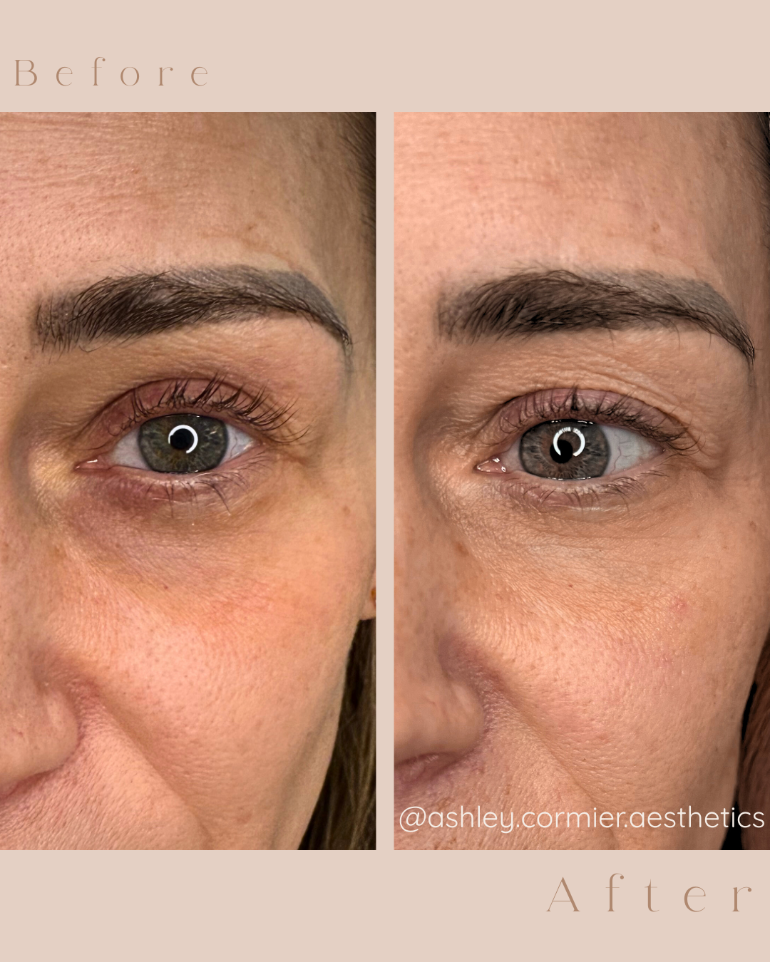 under eye before and after images - results in the after image are from three under eye prf treatments 