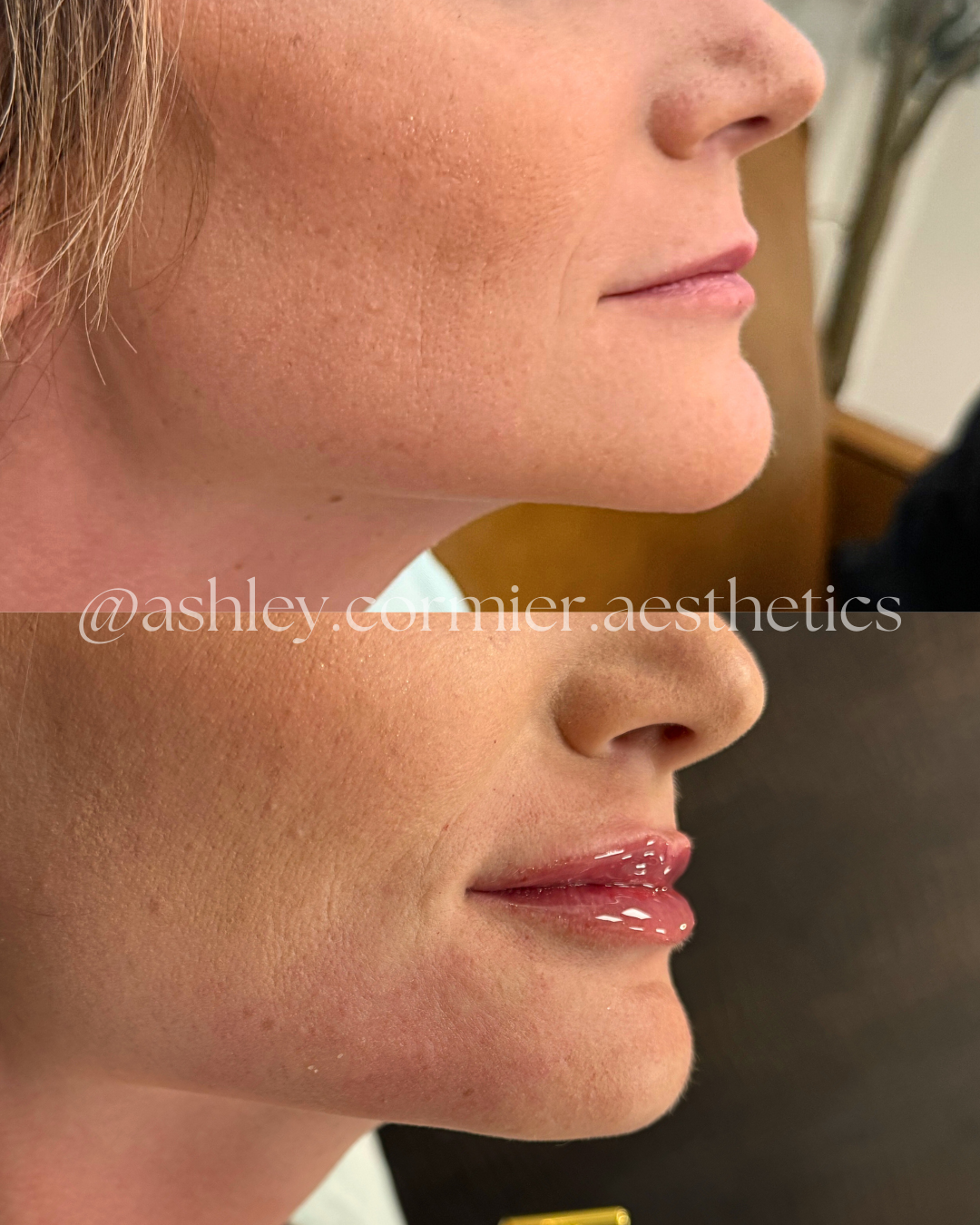 before and after a half syringe of lip filler