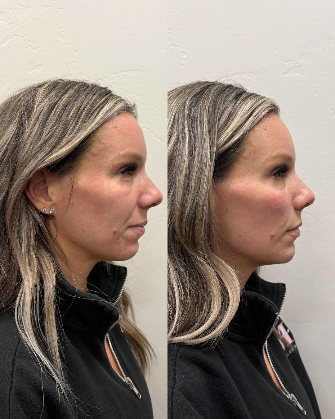 Cheek and chin filler, Sculptra through the midface