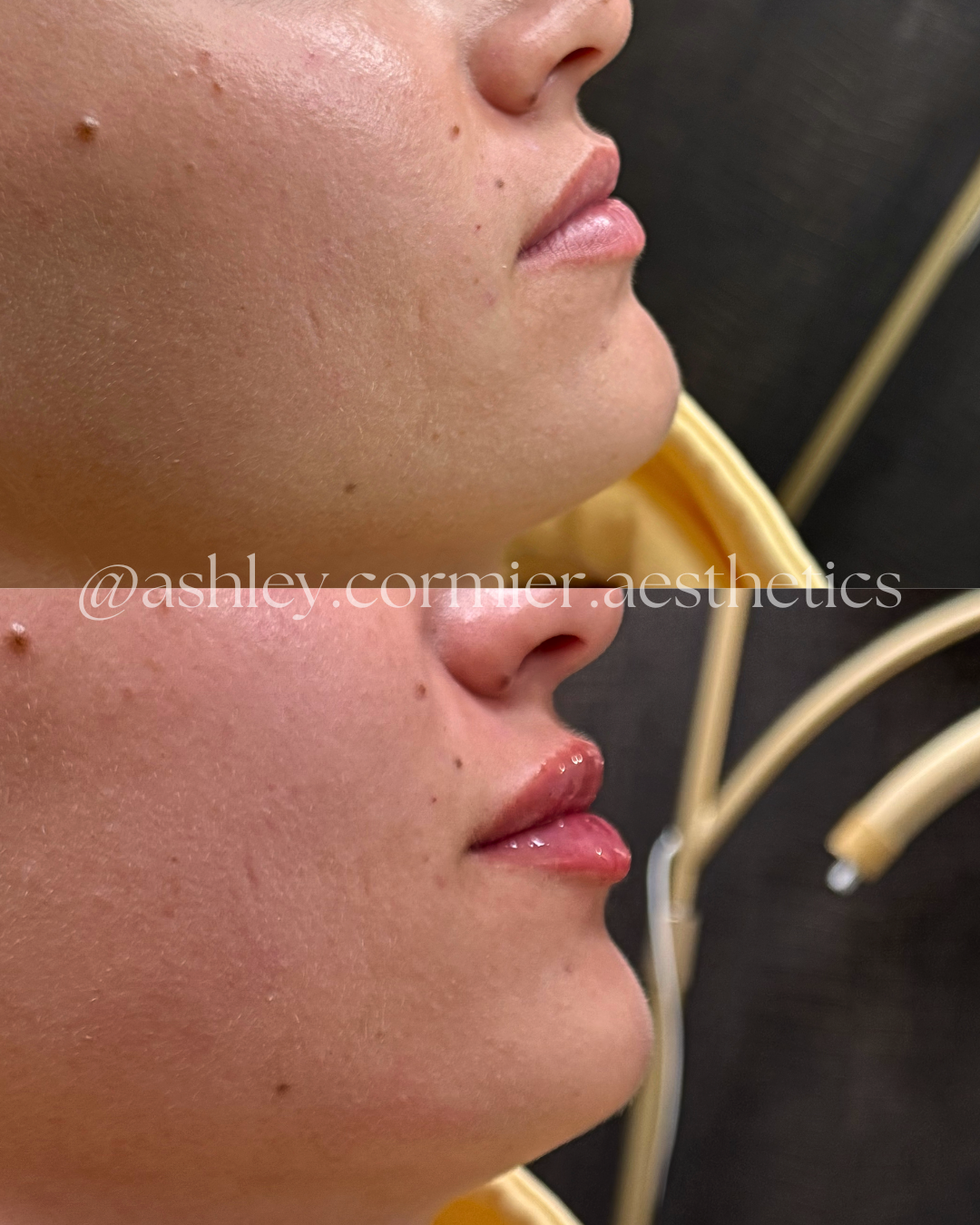 before and after a half syringe of lip filler