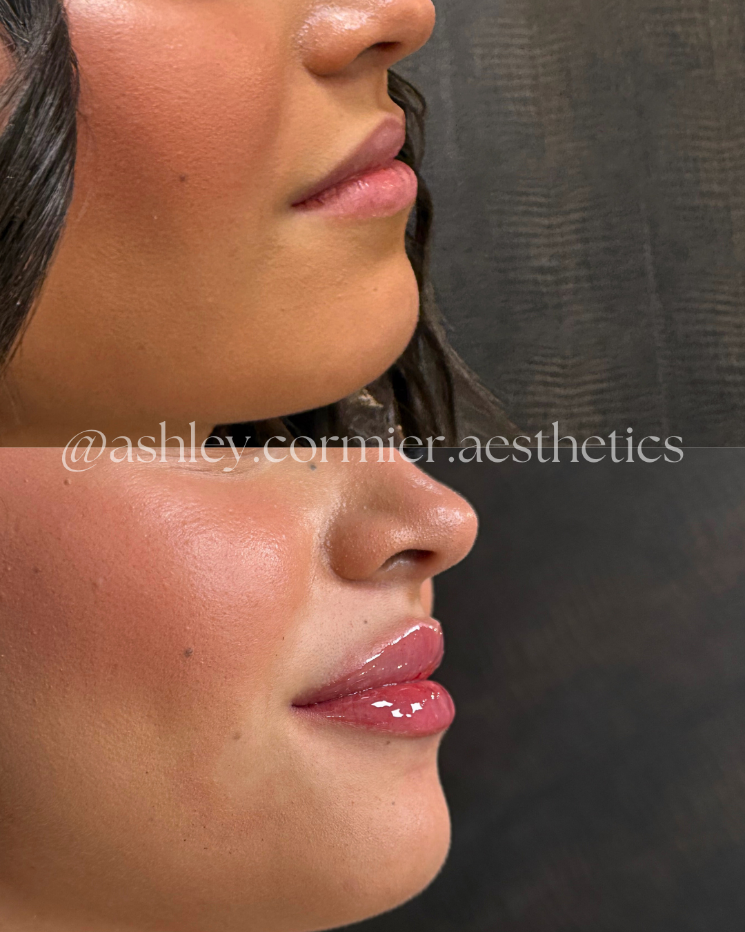 half syringe of lip filler