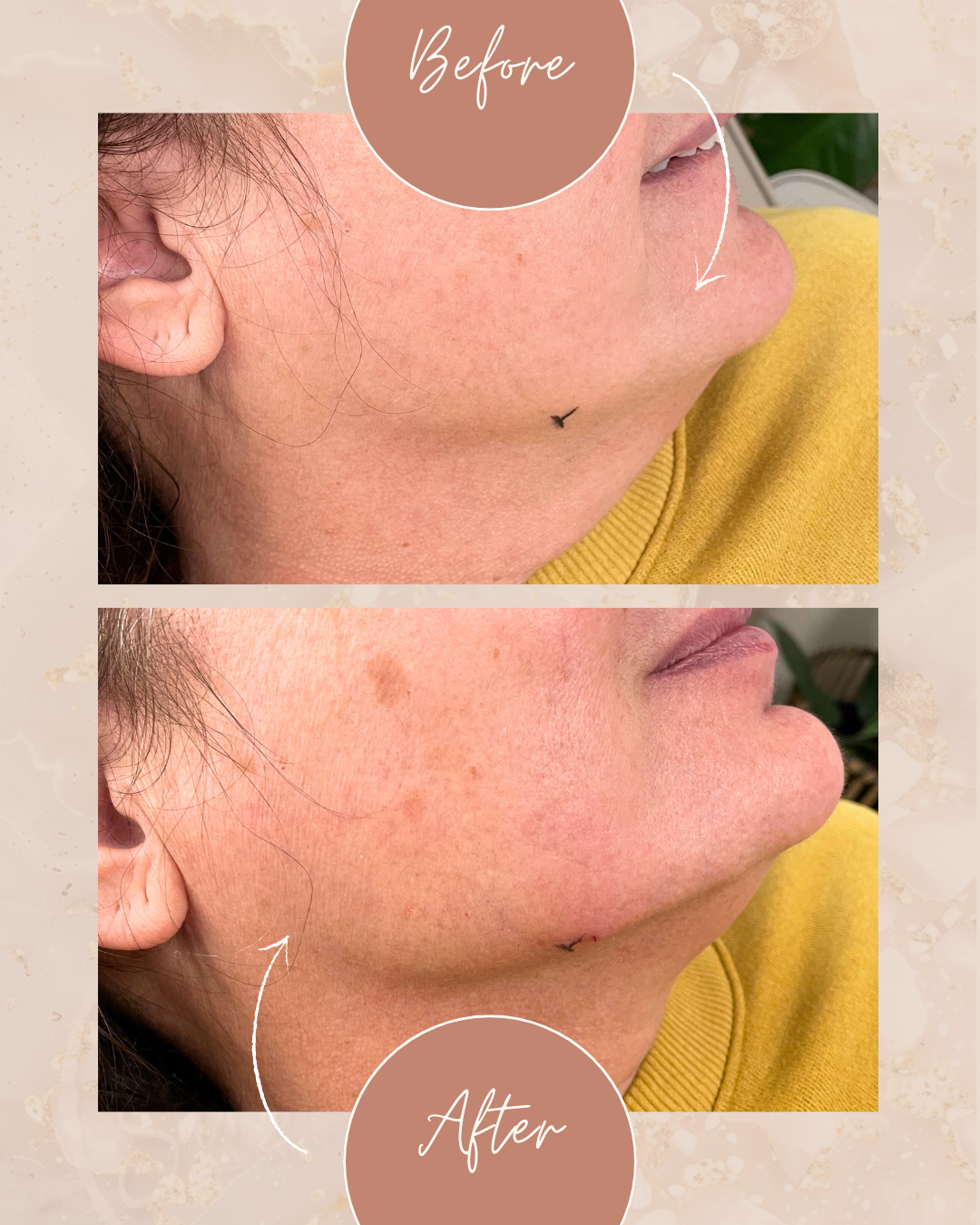 before and after jawline filler