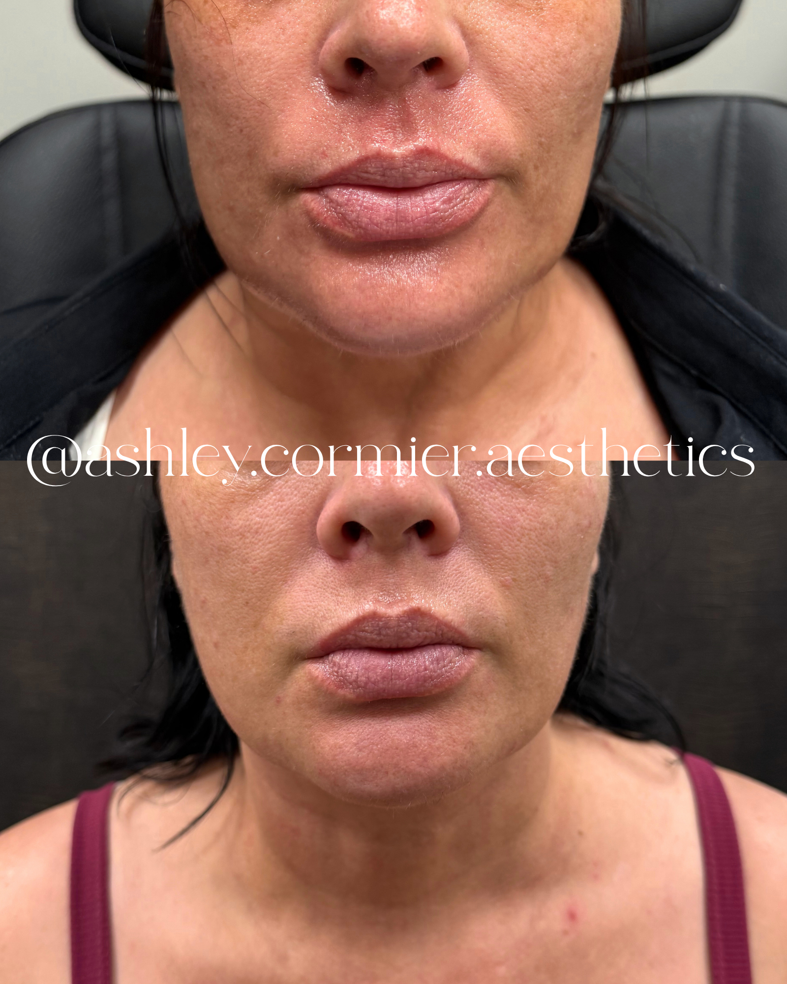 before and after just one Morpheus8 face and neck treatment to slim the jawline and tighten the skin 