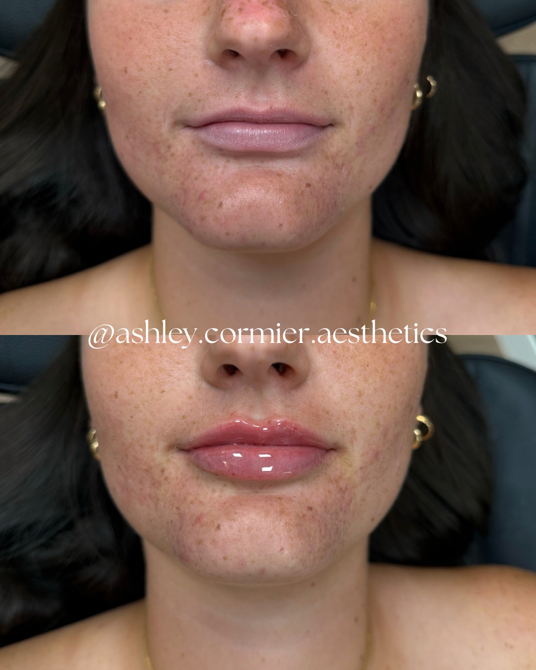 before and after a half syringe of lip filler