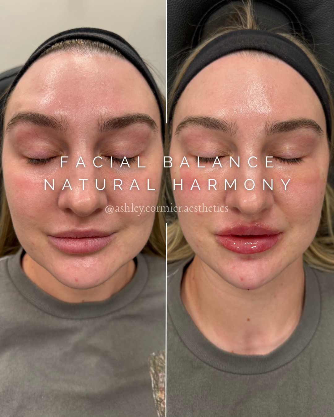 facial balancing with lip and chin filler, under eye prf treatment done as well