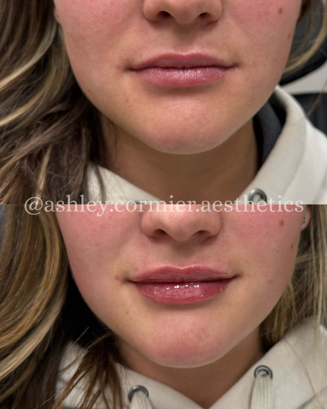 before and after a half syringe of lip filler