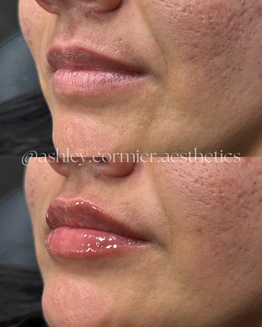 before and after a half syringe of lip filler