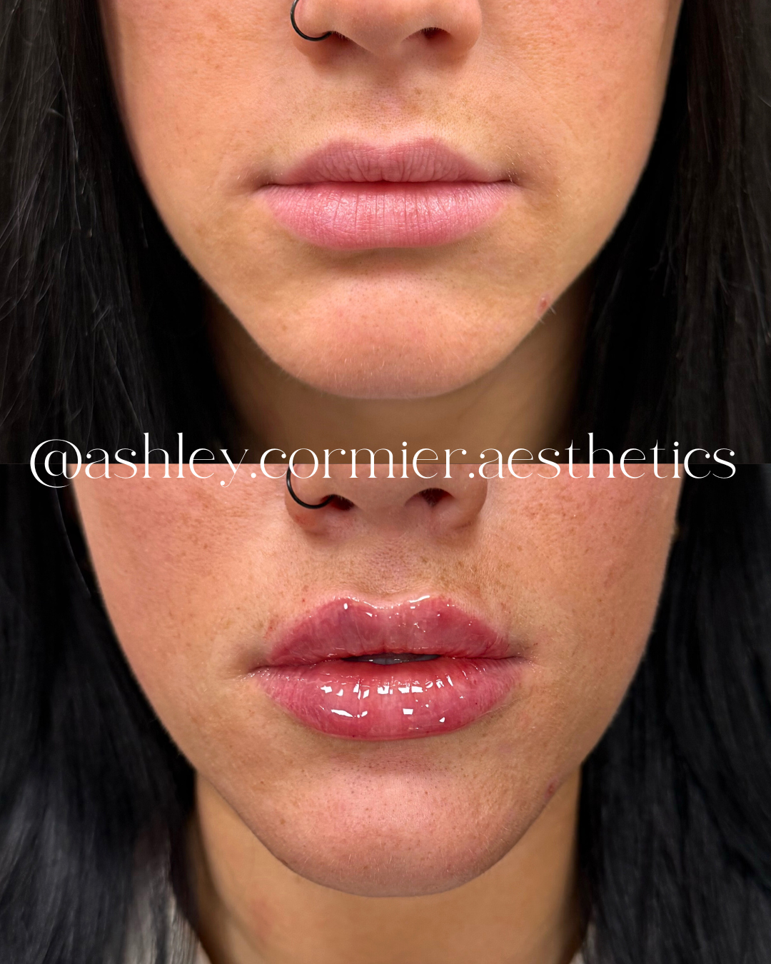 before and after a half syringe of lip filler