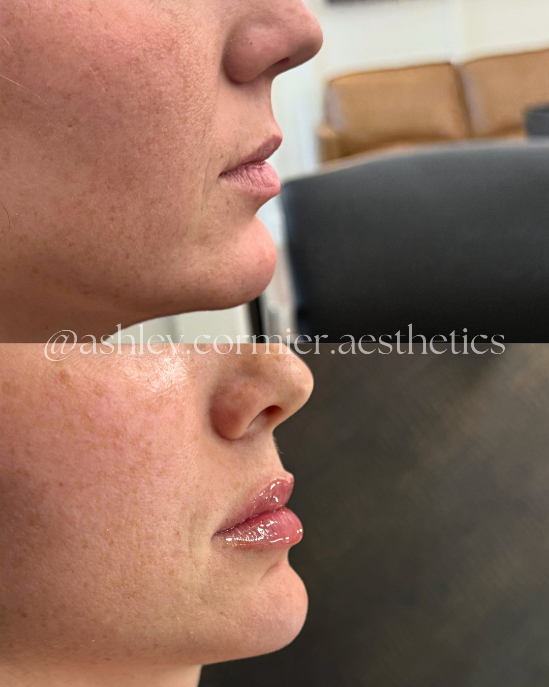 before and after a half syringe of lip filler