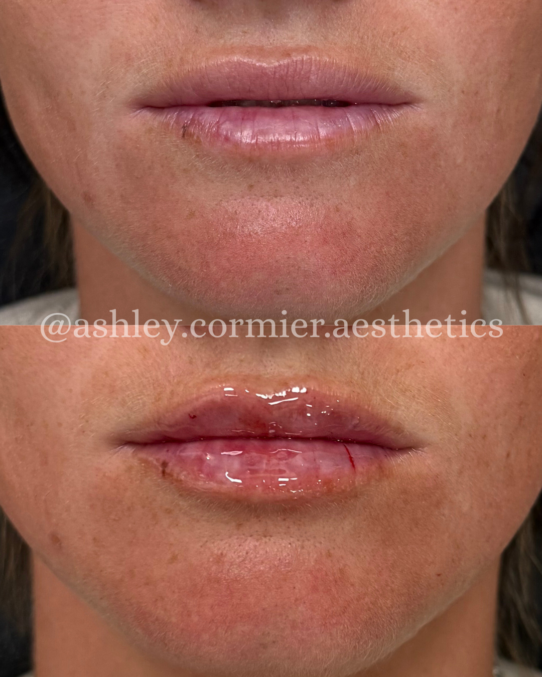 before and after a half syringe of lip filler