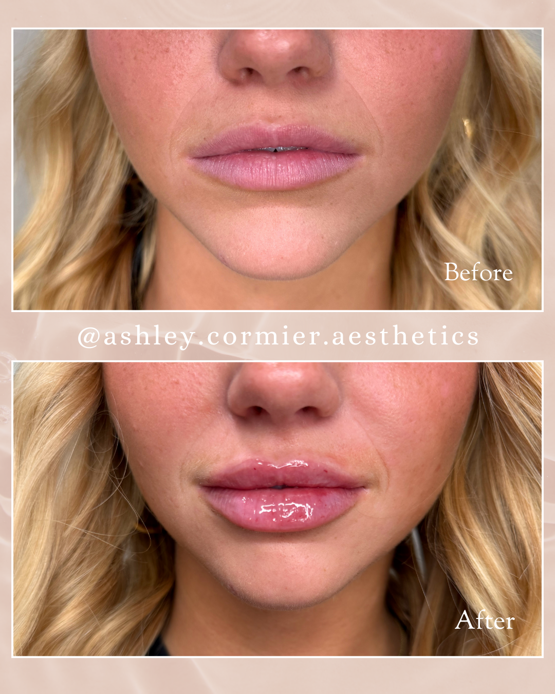 before and after a half syringe of lip filler