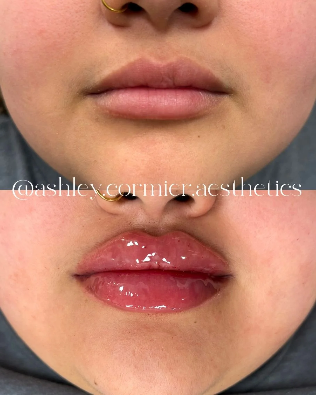 Copy of Lip filler 2.jpg