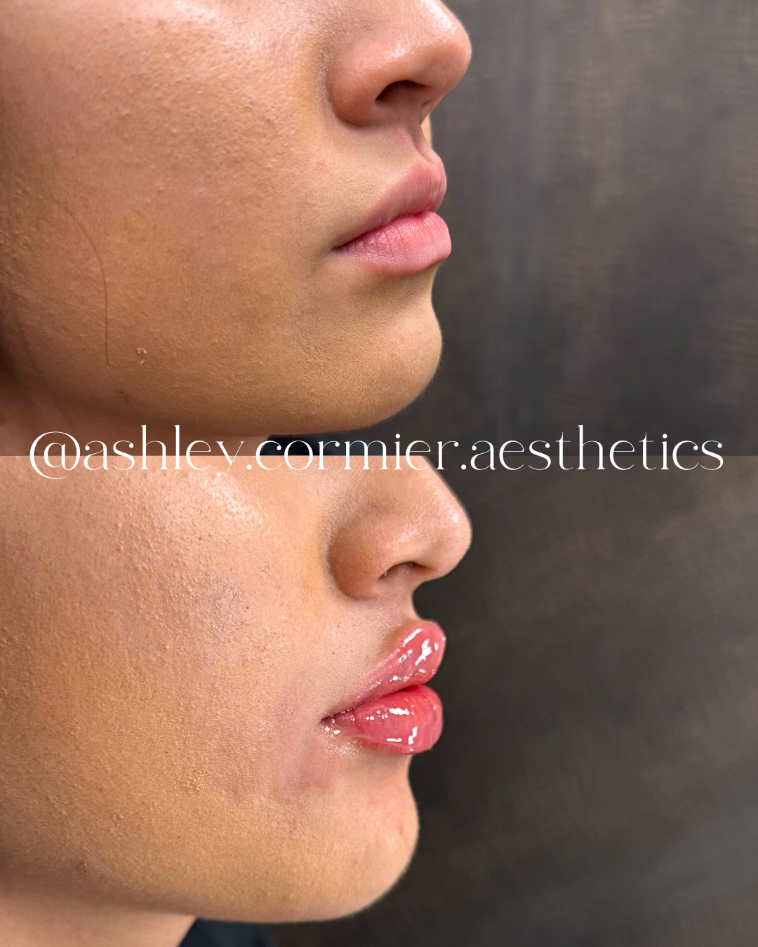 before and after a half syringe of lip filler