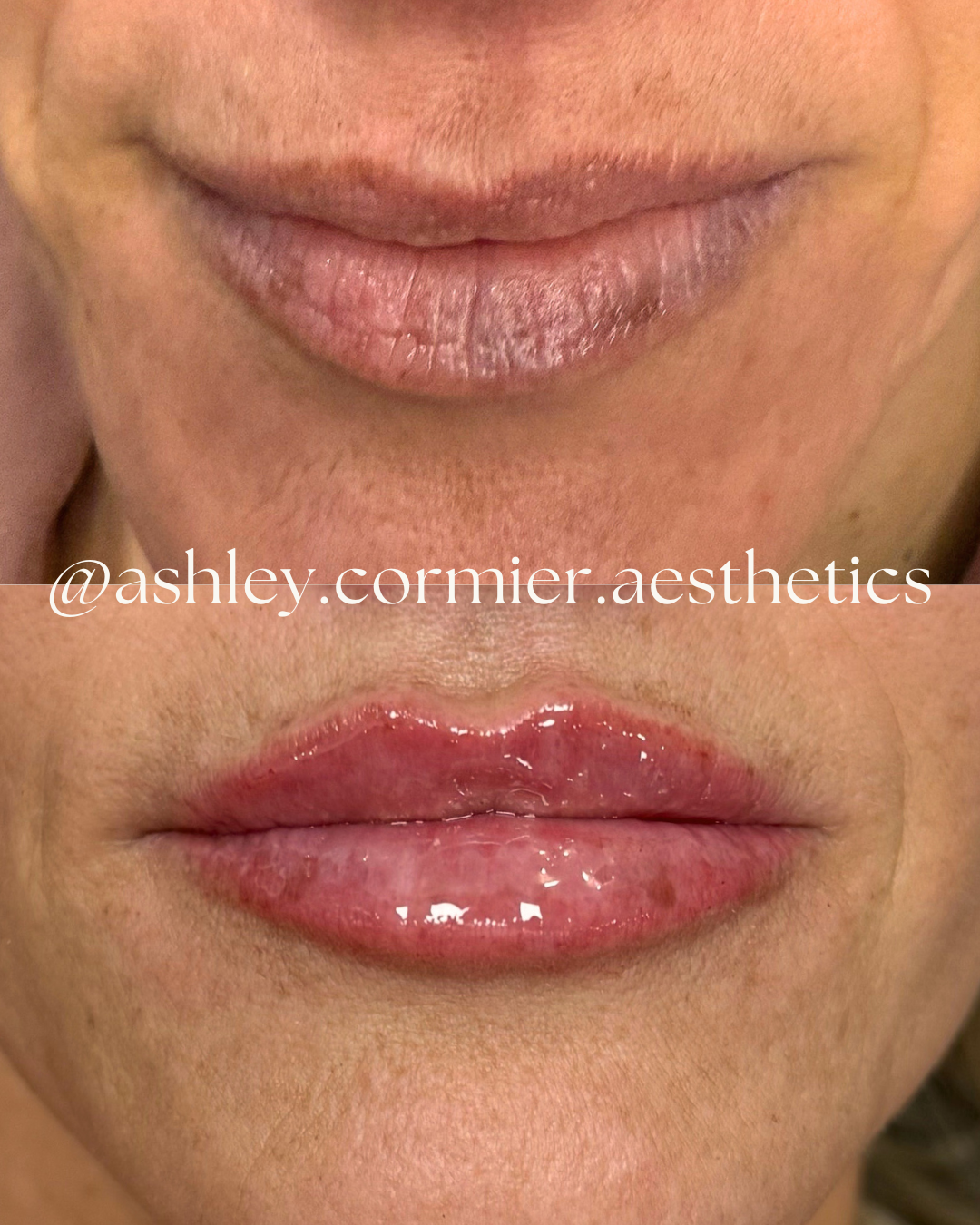before and after a half syringe of lip filler